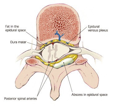 epidural-abscess